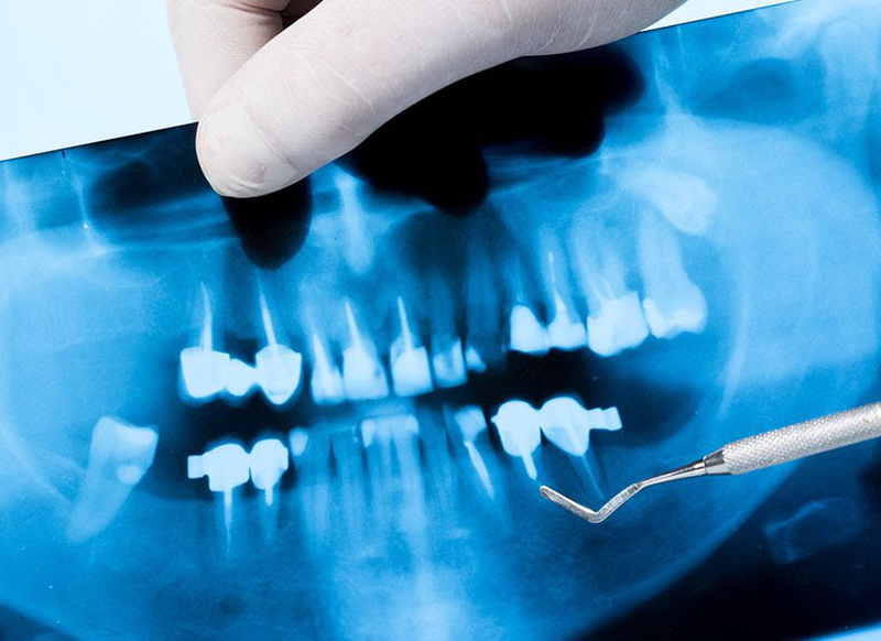 Niềng răng có mấy giai đoạn 2