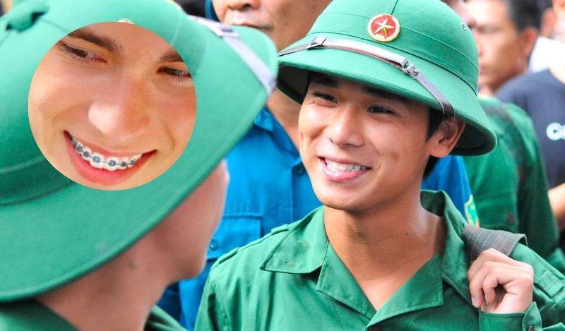 Niềng răng có phải đi nghĩa vụ quân sự không? Tiêu chuẩn nhập ngũ? 2