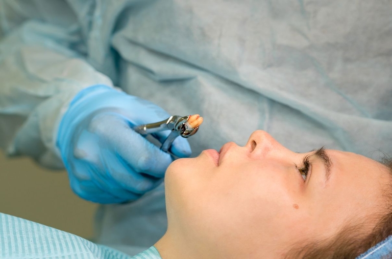 Giải đáp thắc mắc: Niềng răng có phải nhổ răng không 2