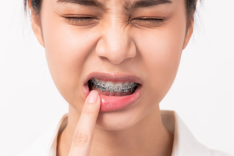 Cảm giác đau nhức sau niềng có thể kéo dài 2 - 4 ngày sau đó