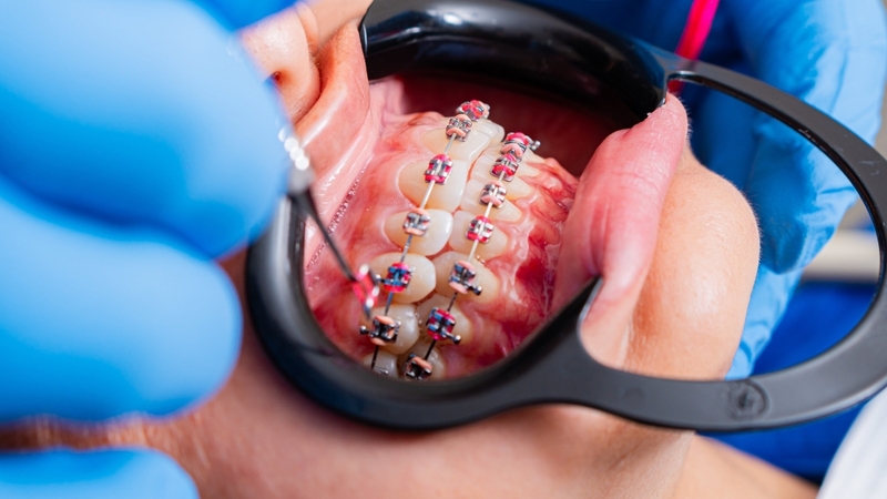 Niềng 2 hàm chi phí cao hơn nhưng đảm bảo khớp cắn chuẩn và hiệu quả lâu dài