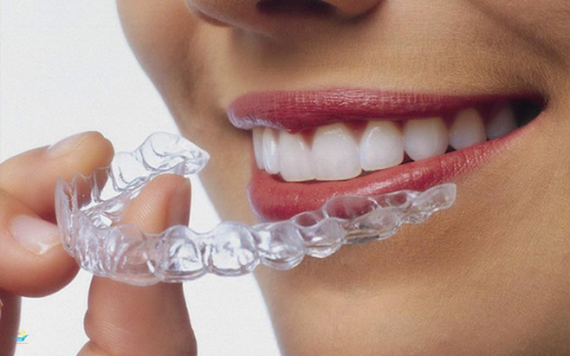 Tìm hiểu chi tiết về niềng răng invisalign1