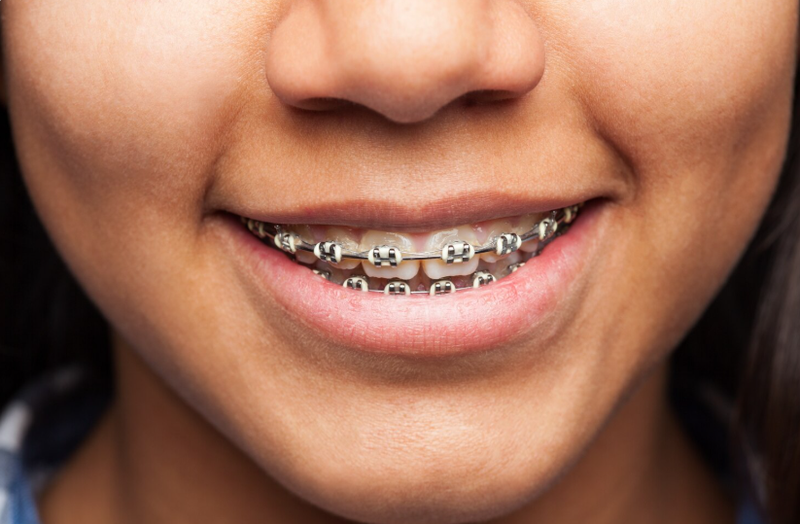 “Niềng răng khấp khểnh bao nhiêu tiền?” chắc hẳn là câu hỏi mà nhiều bạn trẻ thắc mắc hiện nay