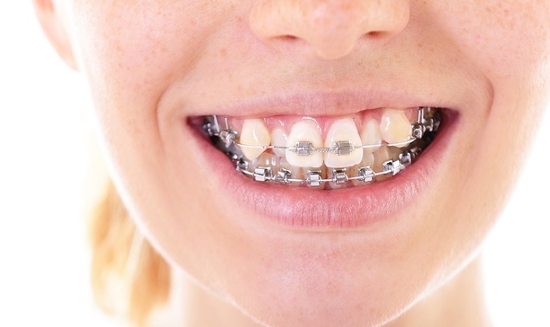 Niềng răng khấp khểnh thời gian bao lâu 3