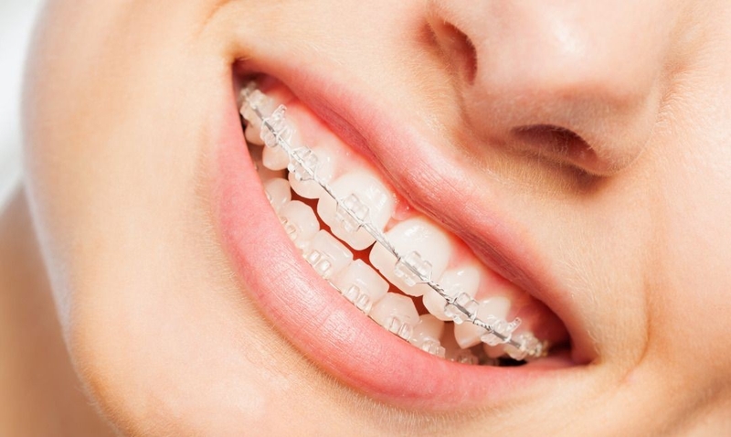 Niềng mắc cài sứ ngày càng được ưa chuộng vì tính thẩm mỹ cao