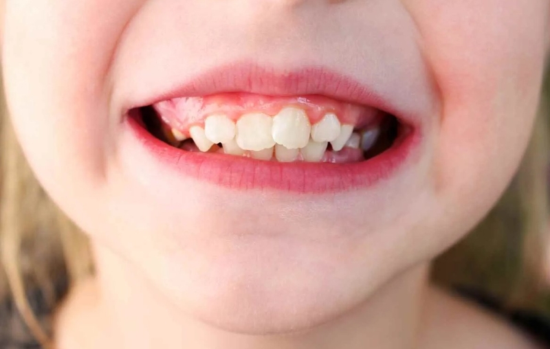 Niềng răng mắc cài mặt lưỡi và những điều bạn nên biết 1