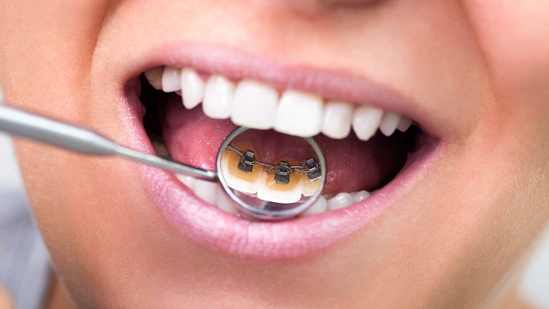 Niềng răng mắc cài mặt lưỡi và những điều bạn nên biết 3