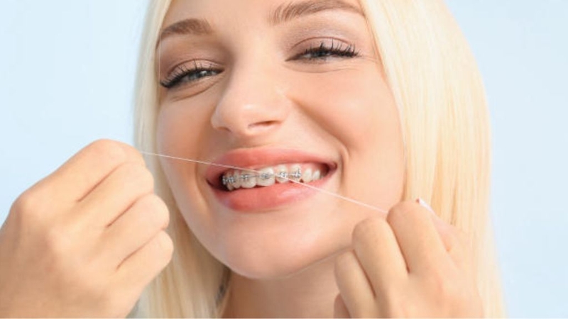 Niềng răng mắc cài sứ dây trong: Đặc điểm, tác dụng 3