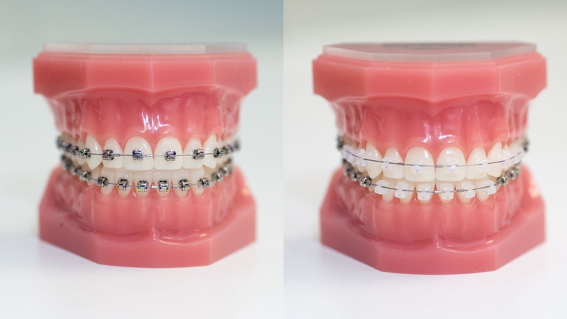 Niềng răng mắc cài sứ và kim loại: So sánh để lựa chọn chính xác! 2