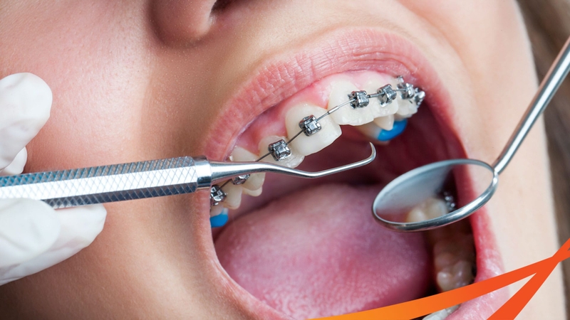 Niềng răng có nên dùng bàn chải điện không? 3