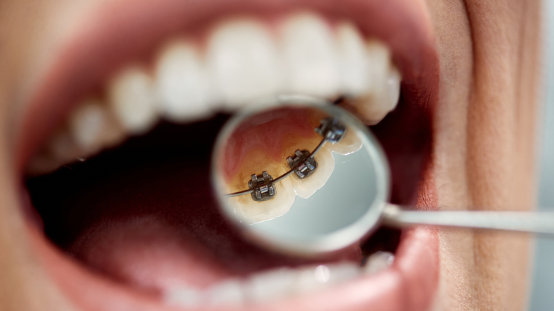 Niềng răng mặt trong (mặt lưỡi) là gì? Ưu nhược điểm và chi phí 1