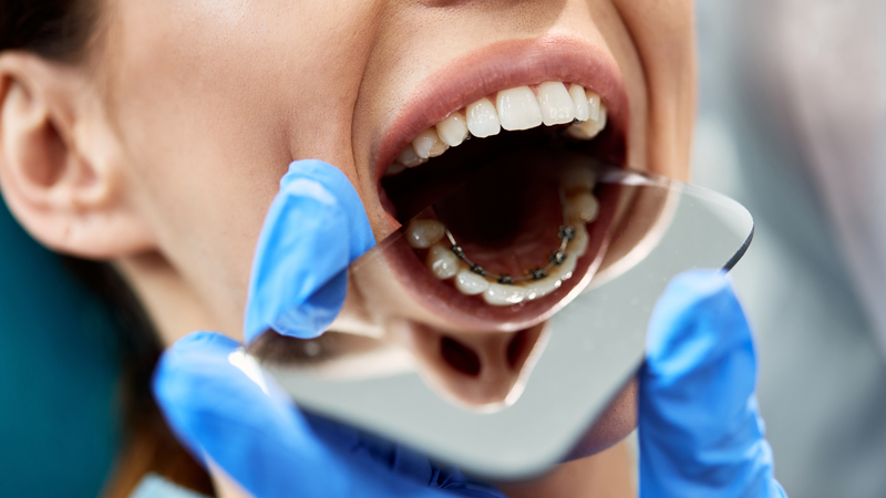 Niềng răng mặt trong (mặt lưỡi) là gì? Ưu nhược điểm và chi phí 2