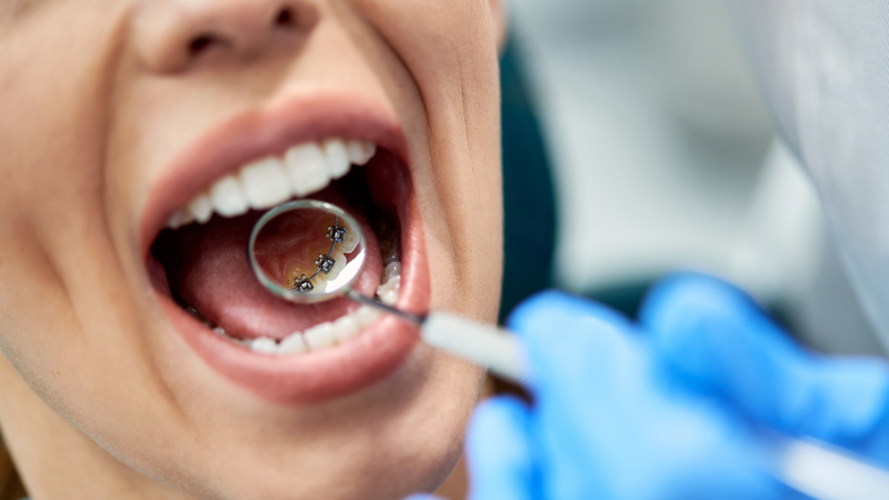 Niềng răng mặt trong (mặt lưỡi) là gì? Ưu nhược điểm và chi phí 3