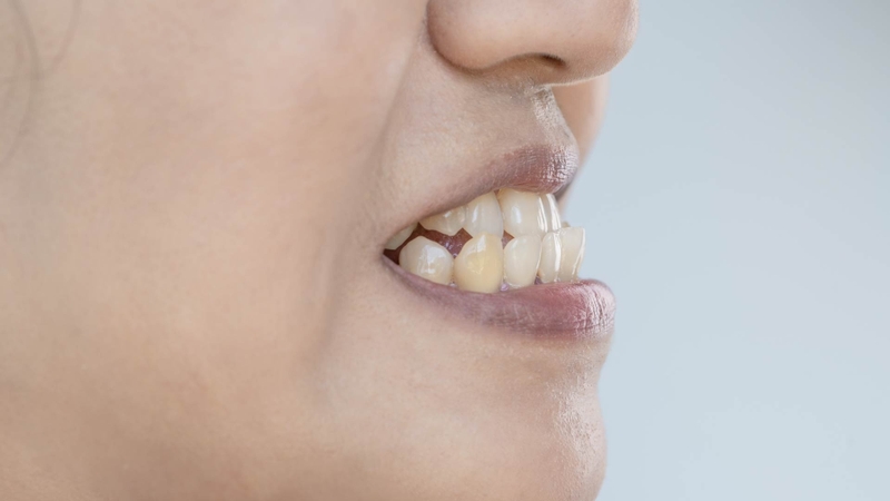 Niềng răng móm có ưu điểm gì? Những điều cần lưu ý trong quá trình niềng răng móm 2