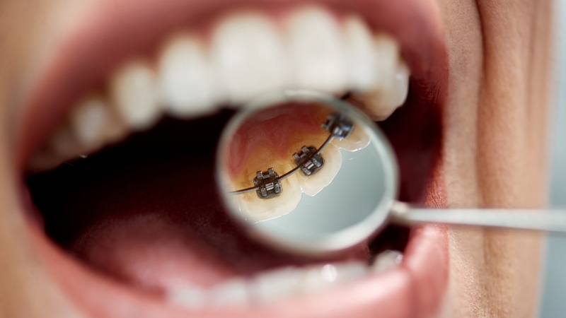 Niềng răng móm có ưu điểm gì? Những điều cần lưu ý trong quá trình niềng răng móm 5