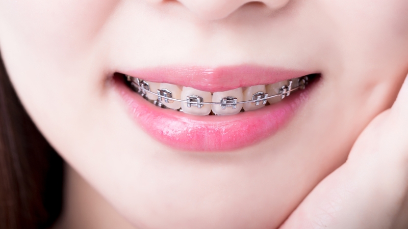 Niềng răng móm có ưu điểm gì? Những điều cần lưu ý trong quá trình niềng răng móm 8