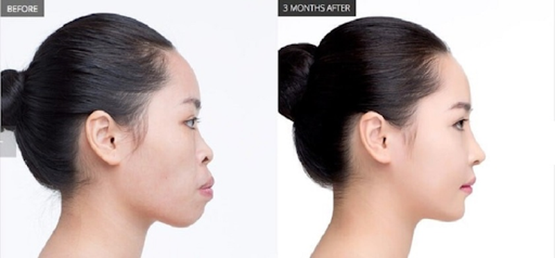 Góc giải đáp: Niềng răng mũi có cao lên không?