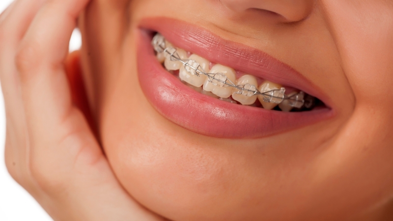 Niềng răng giúp cải thiện thẩm mỹ, ăn nhai, phát âm và sức khỏe răng miệng