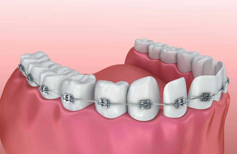 Niềng răng sắt có hiệu quả không? Quy trình thực hiện ra sao 1