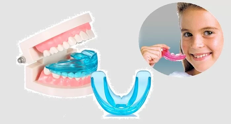 Những điều cần biết về niềng răng silicon