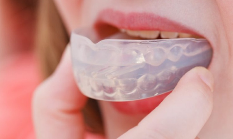 Những điều cần biết về niềng răng silicon