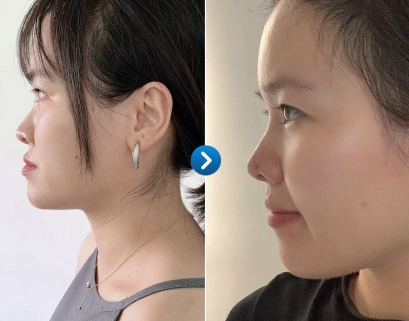 Niềng răng thay đổi góc nghiêng - Đúng hay sai 2