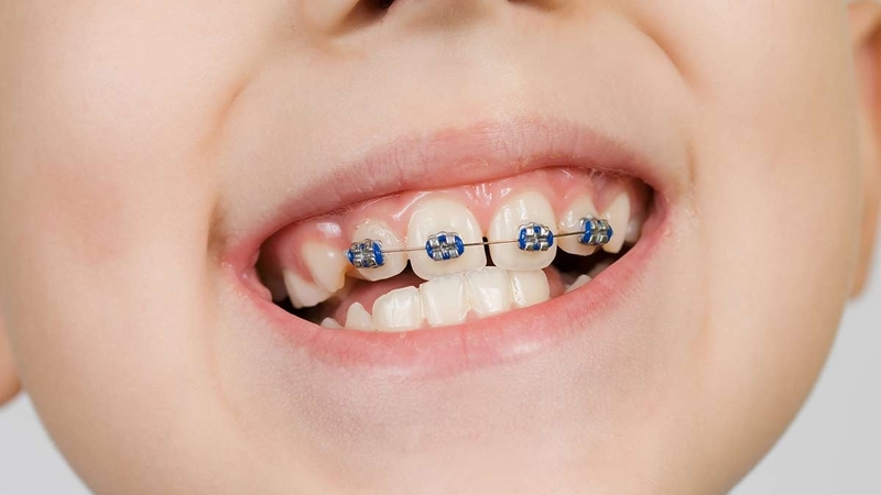 Niềng răng trẻ em giá bao nhiêu tiền? Có nên niềng không? 2