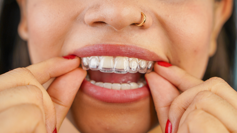 Khay niềng chỉ phát huy hiệu quả khi được đeo đúng theo hướng dẫn