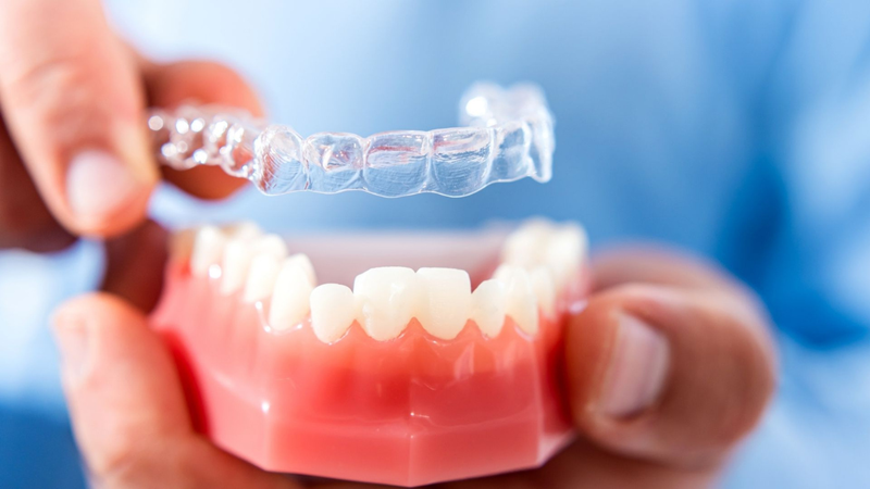 Niềng răng trong suốt giá bao nhiêu? Những điều bạn cần biết 3