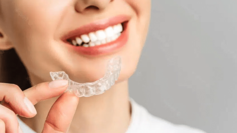 Niềng răng trong suốt giá bao nhiêu? Những điều bạn cần biết 1