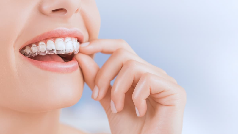 Niềng răng trong suốt giá bao nhiêu? Những điều bạn cần biết 5
