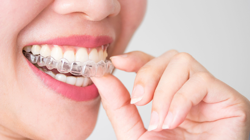 Niềng răng trong suốt giá bao nhiêu? Những điều bạn cần biết 4