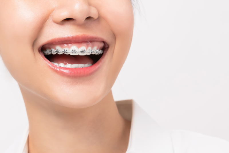 Niềng răng xong bị hô là tình trạng gì?  2