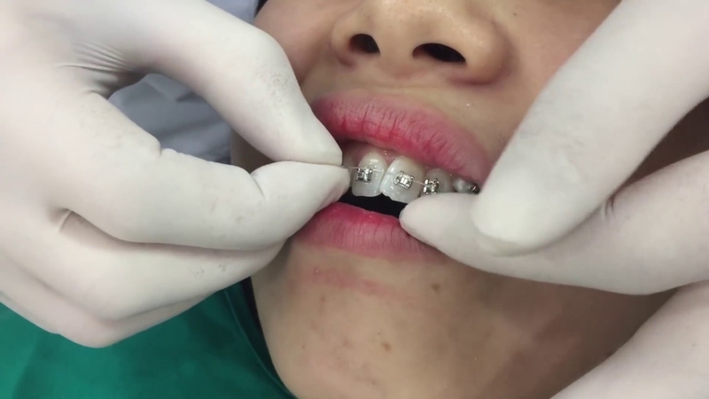 Niềng răng xong có bị chạy lại không?