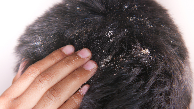 nizoral-co-dung-duoc-cho-ba-bau-khong-cac-lua-chon-thay-the-nizoral-cho-ba-bau 1