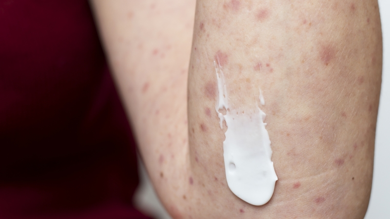 Nổi chấm đỏ trên da: Nguyên nhân và cách xử lý 1