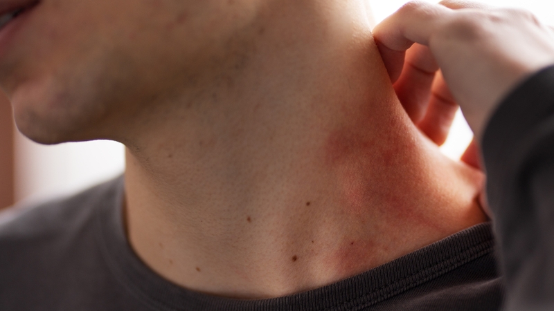 Nổi chấm đỏ trên da: Nguyên nhân và cách xử lý 2