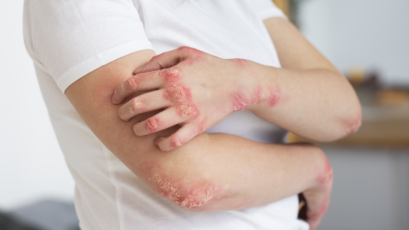 Nổi chấm đỏ trên da: Nguyên nhân và cách xử lý 3