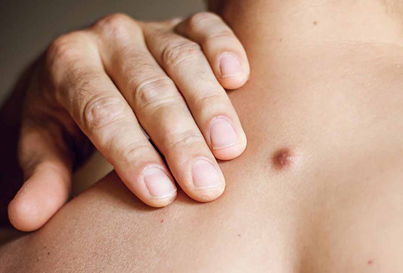 Nổi cục cứng nhỏ dưới da là bị gì? Có nguy hiểm không 2