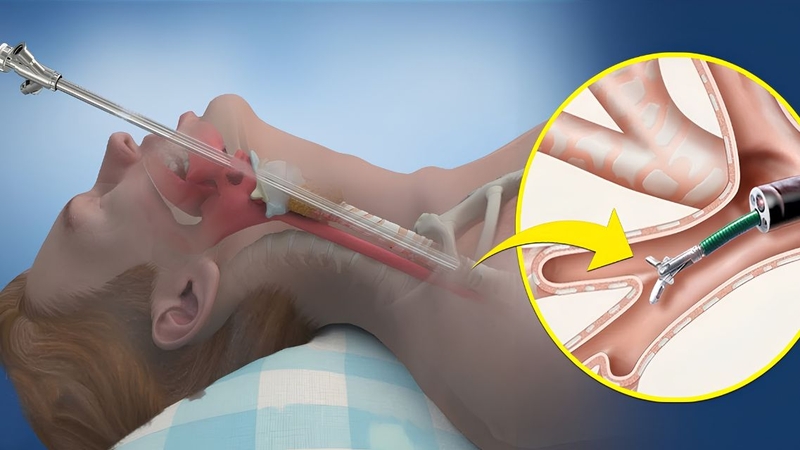 Nội soi phế quản với ánh sáng huỳnh quang giúp phát hiện những thay đổi niêm mạc tinh vi