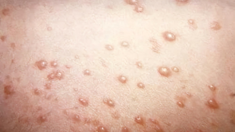 Nổi đốm trắng ở vùng kín nam là bệnh gì và cách điều trị hiệu quả 2