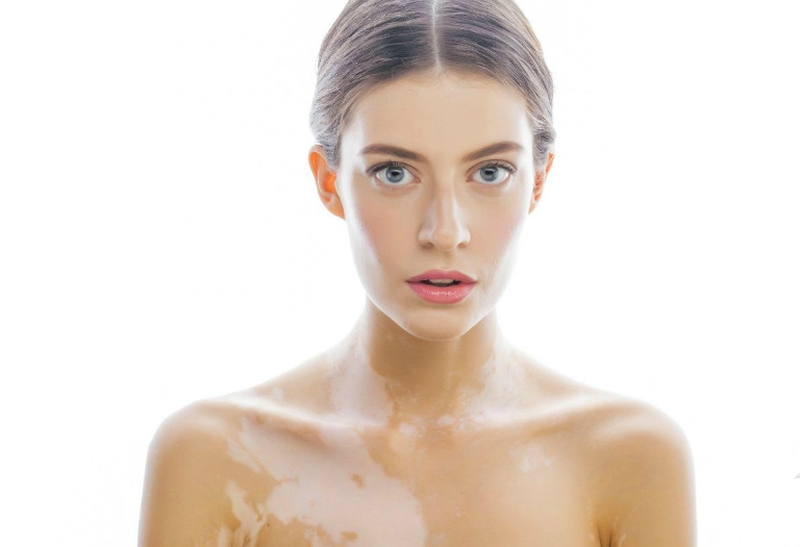 Nổi đốm trắng trên da, dấu hiệu cảnh báo bệnh gì? 2