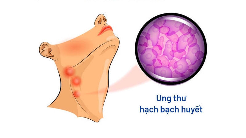 Nổi hạch 2 bên hàm có nguy hiểm không? Khi nào có thể là dấu hiệu ung thư? 2