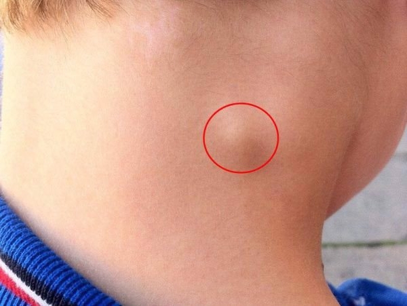 Nổi hạch dưới cằm có nguy hiểm không? Có phải là dấu hiệu ung thư không? 3