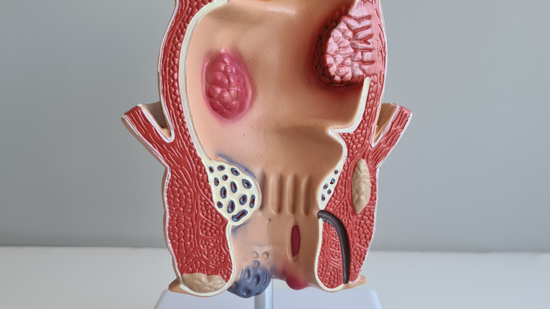 Tụ máu quanh hậu môn gây nổi hạch cứng ở hậu môn