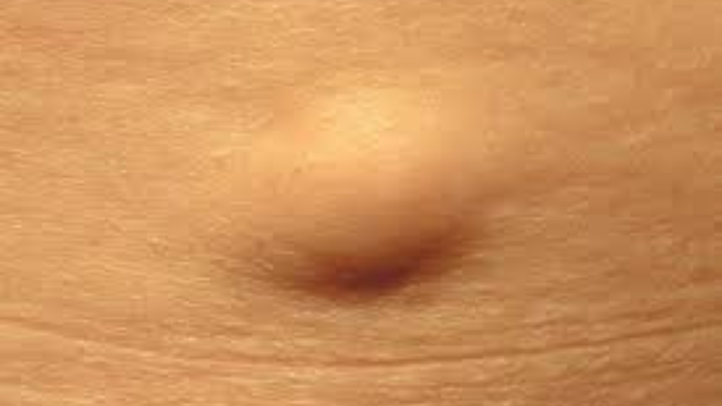 noi-hach-o-hang-o-nam-gioi-va-cach-chua-tri 1