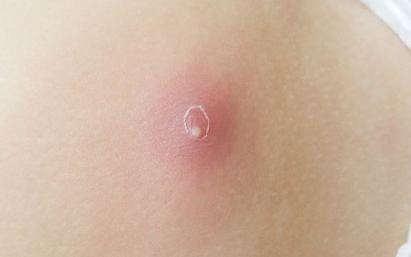 noi-hach-o-mong-la-bi-benh-gi-nen-xu-ly-nhu-the-nao 4