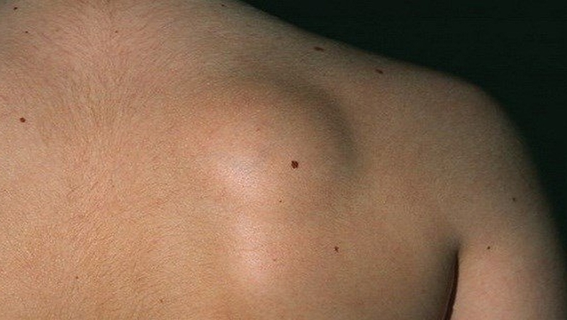 Nổi hạch ở sau lưng là bệnh gì? Những điều cần lưu ý để chăm sóc sức khỏe của bạn 1