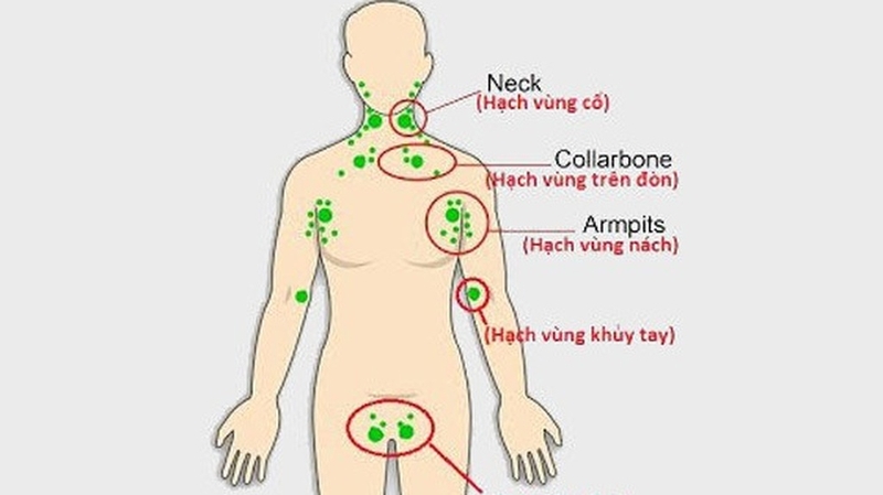 Nổi hạch ở vai là bệnh gì? Có nguy hiểm không? 1