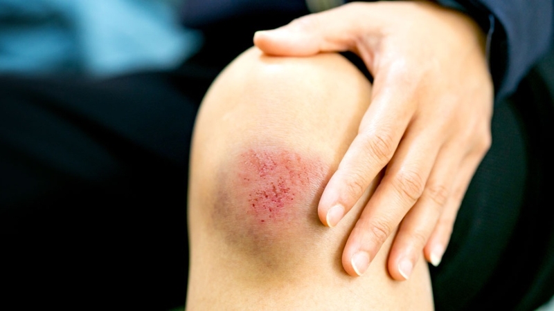 Nổi hạch ở vai là bệnh gì? Có nguy hiểm không? 2